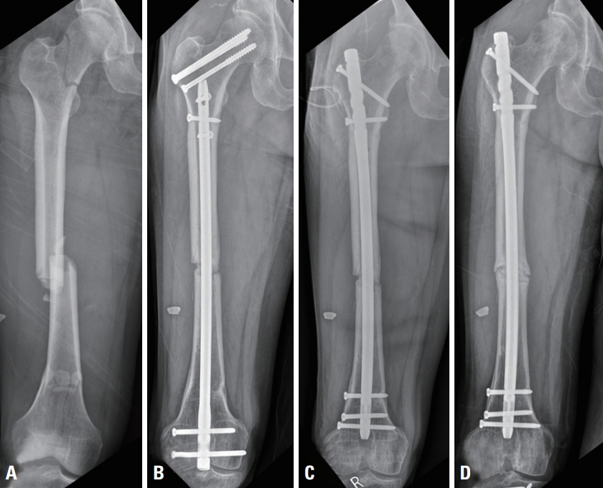 Intramedullary Nailing of Complete Articular Distal Femur Fractures -  ScienceDirect